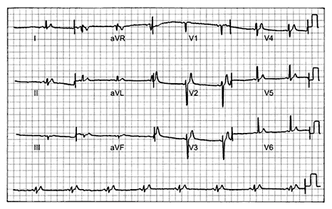 Fig. 2. 12-lead ECG obtained from the 37-year-old victim of sudden cardiac death. Note: QTI duration 266 ms; heart rate 52 bpm; predictive value of the QTI 431 ms; QT interval duration of 62% of predictive value; QTc (by Bazzet’s formula) 248 ms; QRS duration 86 ms.