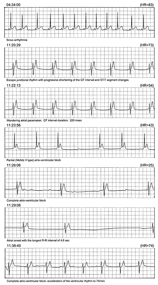 Fig. 3. An episode of bradyarrhythmias accompanied by deceleration-dependent shortening of the QTI and liable T wave. 04:34:00: Sinus arrhythmia with normal QTI. 11:20:29: Escape junctional rhythm with progressive shortening of the QTI and tall T wave. 11:22:13: Wandering atrial pacemaker; QTI duration 220 ms; heart rate 54 bpm. 11:23:56: Escape (supraventricular) rhythm with partial (Mobitz II type) atrioventricular block. 11:26:06: Complete atrioventricular block with the shortest QTI duration of 216 ms (third complex). 11:29:06: Atrial arrest with the RR interval of 4,600 ms. 11:38:40: Complete atrioventricular block with acceleration of the ventricular rhythm to 76 bpm and normalization of the QTI duration.
