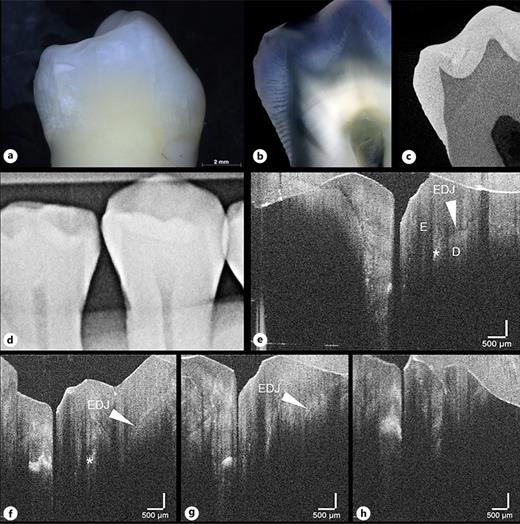 Assessment of tooth 35 mesial: ICDAS ll score 0 (a), light microscopy score 0 (b), µCT score 0 (c), digital radiography R0 (d), and OCT score 0 (e–h). The series of dot-like signals at the EDJ in the OCT cross-sectional images (*) probably represent cohesive defects, as no access of a lesion from the tooth surface can be detected in the 3D image stack (e–h). The signals could be assessed as false positives by inexperienced practitioners. E, Enamel; D, Dentin; EDJ, enamel-dentin junction.