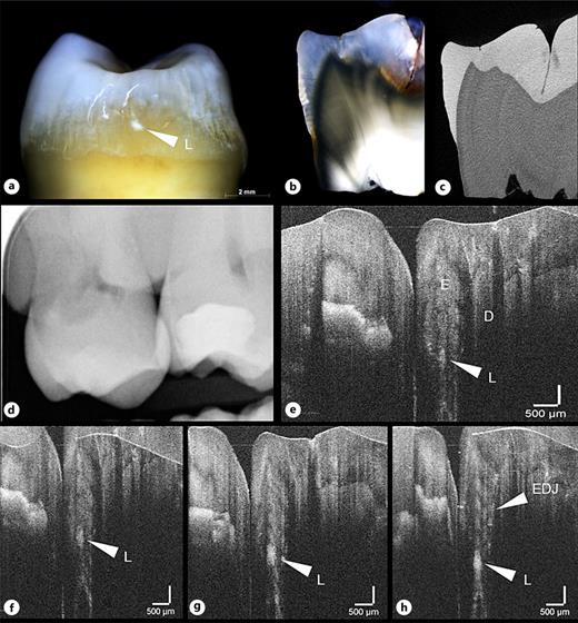 Assessment of tooth 17 mesial: ICDAS score 1 (white arrow (a)), light microscopy score 3 (b), µCT score 0 (c), digital radiography not assessable due to interference (d), and OCT score 3 (e–h). With OCT, no overlapping of the proximal surfaces occurs as with (d), and the lesion is detectable in different planes, tracing the spread from the tooth surface into the enamel in real time. E, Enamel; D, Dentin; EDJ, enamel-dentin junction; L, carious lesion.