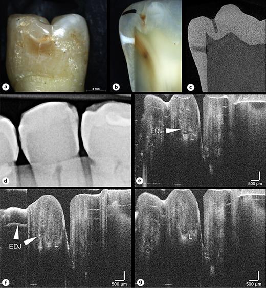 Tooth 15 distal with ICDAS score 2 (a), light microscopy score 5 (b), µCT score 4 (c), digital radiography R1 (d), and OCT score 5 (e–g). The spread and morphology of the lesion can be assessed from tooth surface up to dentin at different planes. EDJ, enamel-dentin junction; L, carious lesion.