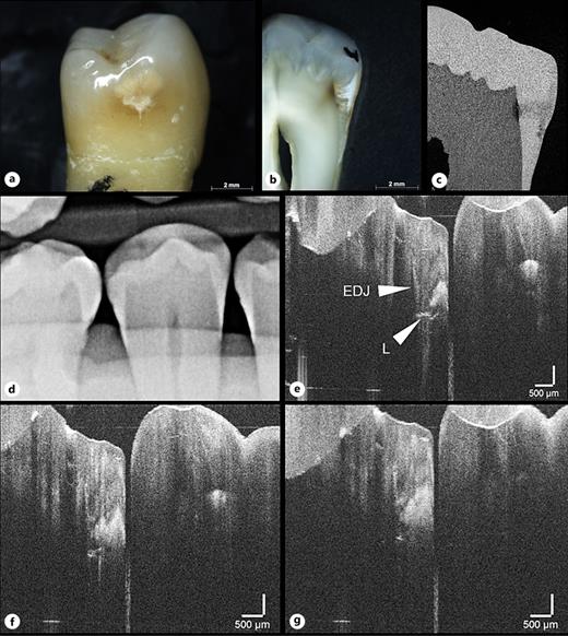 Tooth 45 distal with ICDAS score 3 (a), light microscopy score 5 (b), µCT score 5 (c), digital radiography R2 (d), and OCT score 5 (e–g). The morphology of the lesion is revealed by OCT as well as light microscopy and X-ray µCT: underneath the well-mineralized pseudo intact surface, the mineral loss in the body of the lesion varies and extends to and further into the dentin. EDJ, enamel-dentin junction; L, carious lesion.