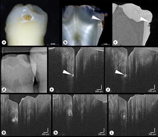 Tooth 34 distal with ICDAS score 3 (a), light microscopy score 3 (b), µCT score 3 (c), and OCT score 5 (e–i). Due to superimpositions, digital radiography is not assessable (d). The cavitation is visible by light microscopy (b), by µCT (c), and by OCT (e, f). The upper cavity margin (white arrow) appears as bright and sharp signal with OCT. L, carious lesion.