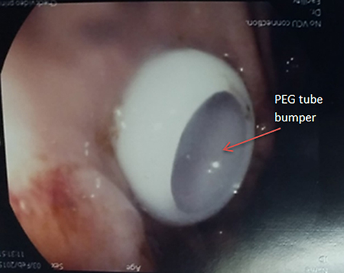 Fig. 1. Endoscopic confirmation of the bumper position (the arrow shows the PEG tube bumper).
