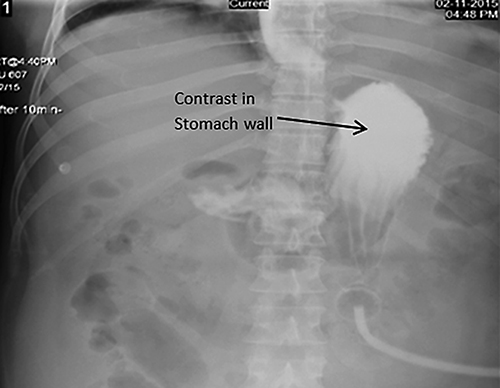 Fig. 2. Gastrografin study showed proper position of the gastrostomy tube in the stomach with no leak around (the arrow shows the contrast in the stomach wall).
