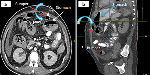 Fig. 3. a CT scan abdomen with oral and i.v. contrast showed no collection or leakage but suspicion of bumper position at the stomach edge with intraperitoneal fluid collection (the white arrow indicates the stomach and the red arrow shows the bumper). b CT scan of the abdomen with oral and i.v. contrast showed no leakage but suspicion of bumper position at the stomach edge with intraperitoneal fluid collection (the white arrow indicates the stomach and the red arrow shows the bumper).