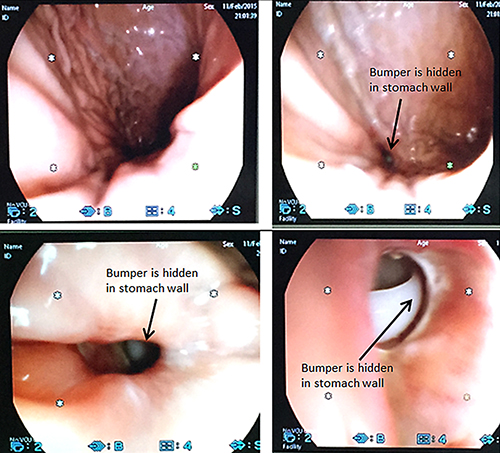 Fig. 4. Endoscopic diagnosis of BBS (arrows show that the bumper is hidden in the stomach wall).