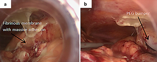 Fig. 5. a Laparoscopic exploration showed free pus and massive adhesions (the arrow indicates the fibrinous membrane with massive adhesion). b Laparoscopic exploration showed the tube bumper at the inner abdominal wall which slipped after dissection (the arrow indicates the PEG bumper).