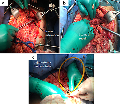 Fig. 6. a Laparotomy: stomach perforation (black arrow). b Laparotomy: repair of the stomach wall (black arrow). c Laparotomy: jejunostomy feeding tube (black arrow).