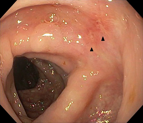 Fig. 1. Linear ulcerations (arrowheads) in the hepatic flexure and descending colon.