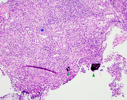Fig. 2. H&E stain showing crystal fragments (arrowheads) and ulceration with granulation tissue (asterisk). Original magnification. ×200.