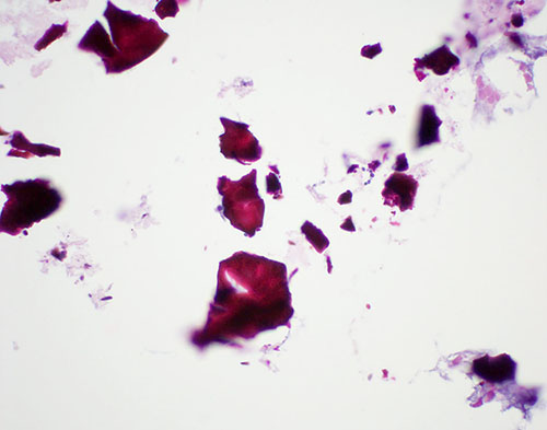 Fig. 3. H&E stain with a high-power view of the crystal fragments. Original magnification. ×600.