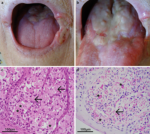 Fig. 1. a, b Fibrinous detritus-covered lesions of the tongue and angular cheilitis with irregular borders and hemorrhagic impingement in disseminated histoplasmosis clinically mimicking malignant disease (e.g., squamous cell carcinoma). c Biopsy taken from oral lesions showing diffuse inflammatory infiltration with abundant large histiocytes (indicated by asterisks), harboring multiple oval, pale eosinophilic bodies (indicated by arrows) with HE staining (40× magnification), morphologically suspicious of intracellular microorganisms. d Periodic acid-Schiff staining (40× magnification) of oral biopsy, highlighting round fungal organisms (indicated by an arrow), measuring about 2–3 µm in diameter, consistent with Histoplasma capsulatum.