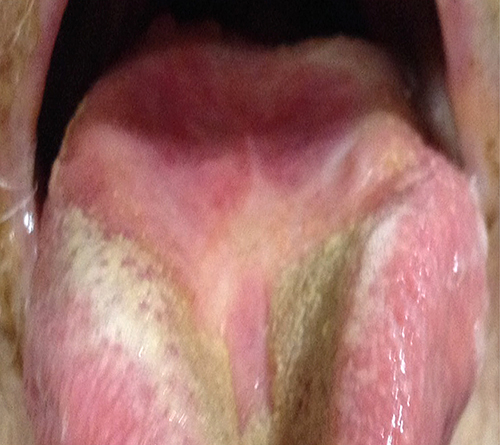Fig. 3. Follow-up of oral lesions after 6 months of therapy with liposomal amphotericin and itraconazole.