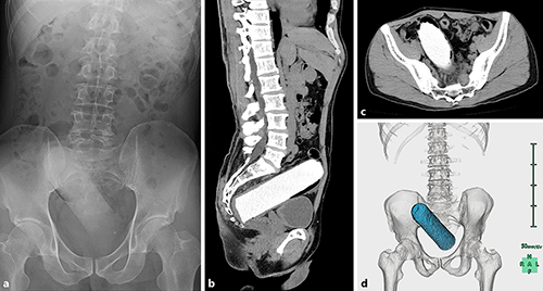 Fig. 1. Abdominal X-ray and CT imaging. a X-ray image showing a foreign body in the pelvic area. b–d Sagittal view (b), axial view (c), and 3-D reconstruction (d) of CT showing the present 18 × 4 × 4 cm, cylindrically shaped object in the rectum. The tip of the foreign body was rounded and the proximal side had a columnar construction.