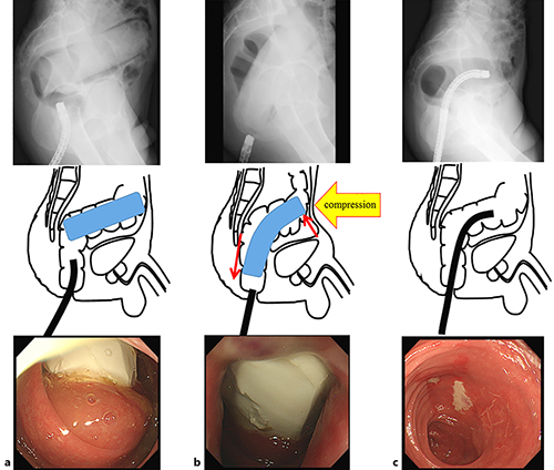 Fig. 2. Transanal manual removal of the foreign body. a X-ray fluoroscopy showing the lateral pelvic view of the foreign body in a rectosigmoid position. b We changed the axis of the foreign body by manual abdominal compression and moved it to the lower rectum, after which we removed it in a transanal manner by manual extraction. c Sigmoidoscopy following extraction showed mild erosion in the rectal mucosa with no findings of bleeding or perforation.