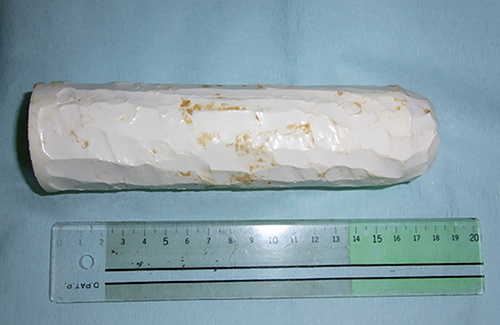 Fig. 3. The foreign body was constructed of silicon material and made by the patient himself (18 × 4 cm).