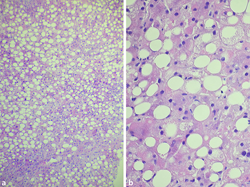 Fig. 1. Photomicrographs of the liver of a 42-year-old man with HHT and alcoholism. a Severe macrovesicular steatohepatitis (original magnification, 100×). b, Severe macrovesicular steatohepatitis (original magnification, 400×). Grade 2 fibrosis was detected with Mallory trichrome staining (not shown). Mallory bodies were not observed.
