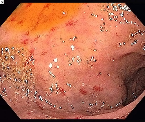 Fig. 2. Multiple spider-like mucosal telangiectases of the gastric antrum and proximal duodenum in a 40-year-old man at the diagnosis of HHT.