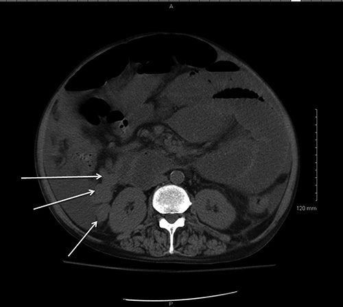 Fig. 3. Noncontrast CT scan transverse image of the abdomen in a 46-year-old man with HHT and alcoholic cirrhosis hospitalized with abdominal pain and fever. This image reveals marked distention of the small intestine, air-fluid levels in the small intestine, absence of free air in the peritoneum, and multiple large varices adjacent to the right kidney (arrows).
