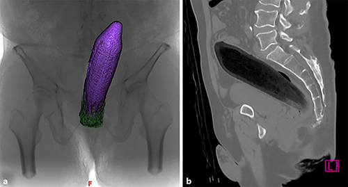 Fig. 1. Computed tomography view of the rectal foreign body of the eggplant. a Foreign body in the coronal section. b Computed tomography view showing the rectal foreign body of the eggplant in the sagittal section.
