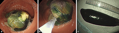 Fig. 2. Endoscopic view of the rectal foreign body of the eggplant. a The rectal foreign body of the eggplant was located in the deep part of the proctosigmoid. b The constriction of the calyx was grasped with a snare and was removed slowly. c Removed rectal foreign body of the eggplant.