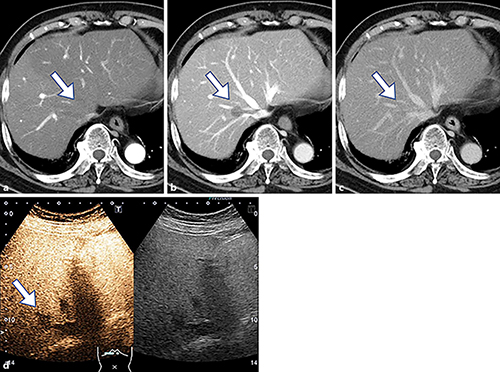 Fig. 1. Findings of dynamic computed tomography and enhanced ultrasonography. The tumor shows isodensity in the arterial phase (a), low density in the portal venous phase (b), and homogeneous enhancement in the late phase (c). Contrast-enhanced ultrasound shows low signal intensity at segment VIII during the Kupffer phase (d).