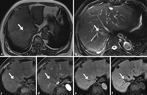 Fig. 2. Findings of magnetic resonance imaging. Magnetic resonance imaging shows the tumor with low intensity on the T1-weighted image (a) and high intensity on the T2-weighted image (b). Dynamic magnetic resonance imaging with Gd-EOB-DTPA-enhanced magnetic resonance imaging shows the tumor is not enhanced in the early phase (c), has low intensity relative to the normal liver at 30 s (d) and 120 s (e) after injection, and shows low signal intensity in the hepatobiliary phase (f).