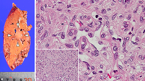 Fig. 3. Macroscopic and histopathological findings of the tumor. The cut surface of the liver explant shows a white-colored tumor, 1.7 × 1.4 cm in diameter (arrowheads) (a). Hematoxylin-eosin staining shows spindle- and oval to polygonal shaped cells with acidophilic cytoplasm (b). Original magnification ×200.