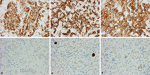 Fig. 4. Immunohistochemical staining of the tumor. Tumor cells are positive for endothelial markers CD31 (a) and CD34 (b), and factor VIII (c). Tumor cells are negative for hepatocyte antigen (d), cytokeratin (e), and D2-40 (f). Original magnification ×200.