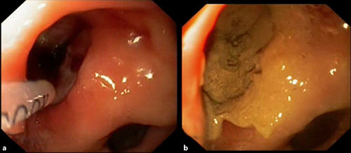 Fig. 1. Esophagoduodenoscopy images. a Peptic ulcer bleeding (Forrest 1b). b Bleeding site after Hemospray application.