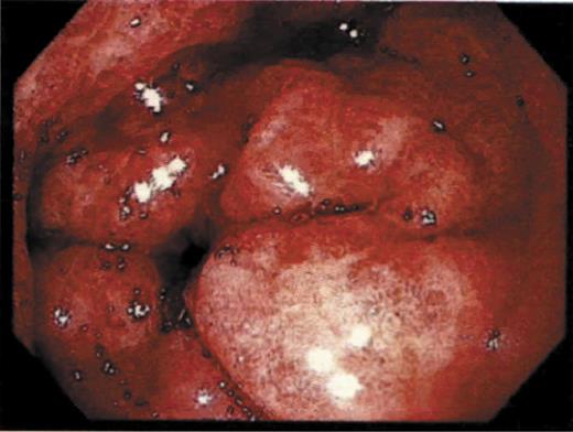 Fig. 1. Endoscopic image of antrum showing diffuse edematous, erythematous mucosa with angiectasias that are diffusely actively oozing blood.