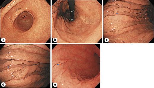 Fig. 1. Endoscopic findings in 2019 (a–d) and 2020 (e). a, b Mucosal atrophy in the antrum and lesser curvature of the corpus. c Nodular lesions on the folds in the greater curvature of the corpus (arrow) in 2019. d Close-up view of salmon roe-like nodular lesions on the folds (arrow). e Nodular lesions on the folds (arrow) in 2020.