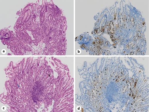 Fig. 2. Histopathological findings in 2020. a, b The flat mucosa in the greater curvature of the corpus shows atrophic changes of fundic glands with pseudopyloric metaplasia and linear hyperplasia of ECL cells. H&amp;E staining, ×100 (a), chromogranin A staining, ×100 (b) c, d Nodular lesions in the greater curvature of the corpus show lymphocytic infiltration in the deep lamina propria, fundic gland destruction with associated apoptosis (black arrow), and pseudohypertrophy of residual parietal cells (blue arrow). (H&amp;E. ×100 (c), chromogranin A staining, ×100 (d)). H&amp;E, hematoxylin and eosin.