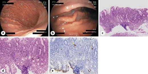Fig. 3. Endoscopic and histopathological findings in 2014. a Enlarged folds and sticky mucus in the greater curvature of the corpus. b Close-up views of salmon roe-like nodular lesions on the folds (arrow). c A low-power view shows full-thickness inflammation in the greater curvature of the corpus (H&amp;E. ×100). d A high-power view shows parietal cell pseudohypertrophy (blue arrow), pseudopyloric metaplasia and fundic gland destruction with apoptosis (black arrow) (H&amp;E. ×200). e Nodular hyperplasia of ECL cells (yellow arrow) (chromogranin A staining, ×200).