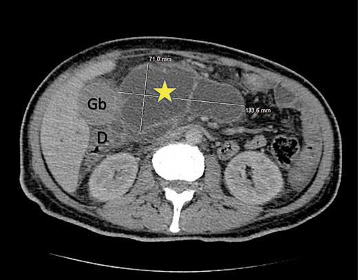 Fig. 1. Abdominal CT scan showing a large biloma: Abdominal axial nonenhanced CT scan image showing a large peri-duodenal liquid collection, measuring: 137 × 15 cm (yellow star). Gb, gallbladder; D, duodenum.