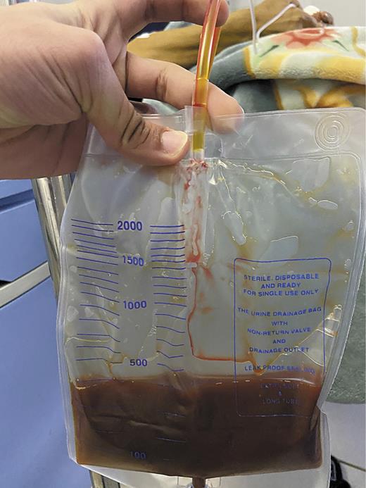 Fig. 2. Photograph of the purulent biliary fluid obtained after the drainage.