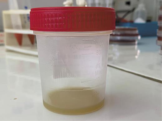 Fig. 3. Photograph of the sample sent for analysis in the laboratory of bacteriology.