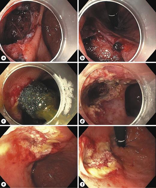 Fig. 1. Endoscopic findings on day 0 in antegrade (a) and inverted (b) view, on day 2 with endosponge in situ (c) and after removal of the endosponge in antegrade view (d), on day 7 in antegrade (e) and inverted (f) view.