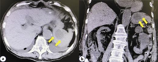Fig. 1. CT shows fluid collection (arrows) in the spleen. a Axial section. b Coronal section.
