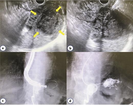 Fig. 2. EUS-guided transgastric drainage. a A splenic abscess (arrows). b A 19-gauge needle is advanced into the cavity. c A 0.025-inch guidewire is coiled in the abscess cavity. d A 6-Fr nasocystic drainage tube is placed.