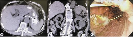 Fig. 3. a CT confirms that the drainage tube is placed in the cavity of the splenic abscess. b The abscess has disappeared. c The external drainage tube is cut and dropped in the stomach.