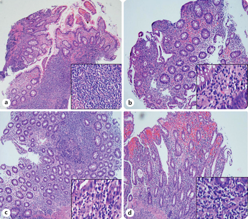 Colonic Dilatation Complicating Acute Severe Ulcerative Colitis Managed ...