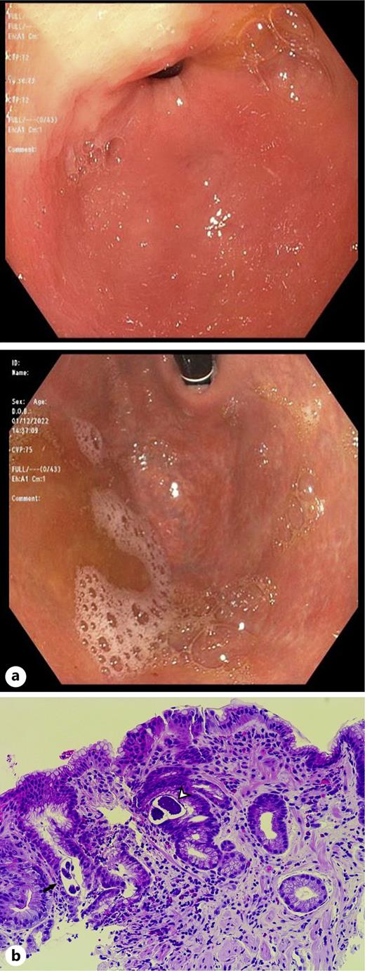 a Upper endoscopy findings in the stomach: atrophic mucosa and diffuse erythema compatible with nonerosive gastritis. b Histopathologic findings from gastric biopsies at ×200 magnification: gastric mucosa with cross-sections of S. stercoralis eggs (white arrowhead) and larvae (black arrow) in the background of an eosinophilic inflammatory infiltrate.