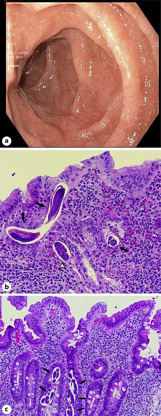 a Upper endoscopy findings in the duodenum: normal mucosa and absence of erythema or erosions or ulcerations. b Histopathologic findings from duodenal biopsies at ×200 magnification: duodenal mucosa with cross-sections of S. stercoralis eggs (white arrowhead), larvae with/without adults (black arrows) with an eosinophilic inflammatory infiltrate. c Histopathologic findings from duodenal biopsies at ×200 magnification: duodenal mucosa with cross-sections of S. stercoralis eggs and larvae (black arrows) with an eosinophilic inflammatory infiltrate.