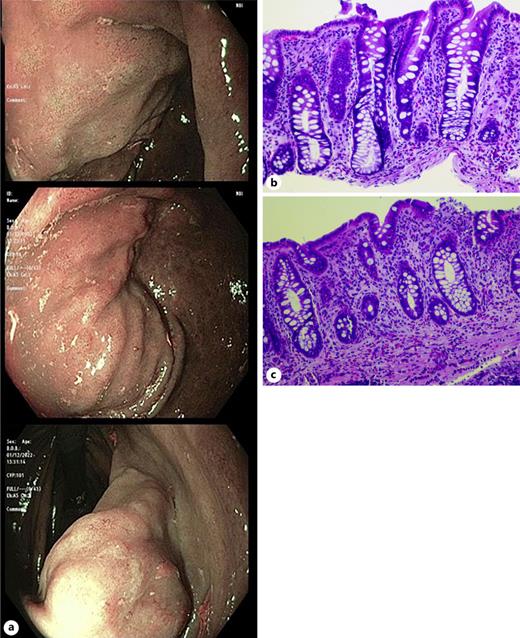 a Cecal mucosa visualized under narrow band imaging showing subtle granularity. b Hematoxylin and eosin image of histopathologic findings from cecal biopsies at ×200 magnification: cecal mucosa with eosinophilic inflammatory infiltrates, chronic inflammation, and hyperplastic changes. c Hematoxylin and eosin image of histopathologic findings from ascending colonic biopsies at ×200 magnification: colonic mucosa with eosinophilic inflammatory infiltrates and chronic inflammation.