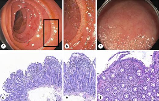 Endoscopic and histological findings at initial presentation following azilsartan intake. Parts of this figure have been published in a different format in an abstract previously [1, 8]. a Endoscopic image of the duodenum showing mucosal “scalloping” as a macroscopic indicator of mucosal changes resembling celiac disease. b Enlarged field of special interest from Figure 1a focusing on mucosal “scalloping.” c Endoscopic image of the terminal ileum showing loss of intestinal villi and flattening of the intestinal mucosa. d Histology of duodenal biopsies demonstrating intraepithelial lymphocytosis, villous atrophy, and crypt hyperplasia. e Enlarged field of special interest from Figure 1d with loss of villi and intraepithelial lymphocytosis. f Histology of the ileal mucosa demonstrating severe villous atrophy and lymphocyte infiltration with cryptitis.