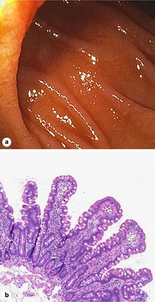 Endoscopic and histological findings after stopping azilsartan. Parts of this figure have been published in a different format in an abstract previously [1, 8]. a Normal endoscopic appearance of the duodenal mucosa 5 months after the last azilsartan exposure. b Corresponding histological image of a duodenal biopsy taken 5 months after stopping azilsartan with normal duodenal mucosa and complete remission from azilsartan-induced villous atrophy.