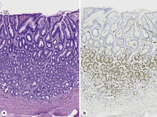 Histopathology from stomach antrum demonstrating increased G-cell population with H&E stain (a) and gastrin immunohistochemical stain (b).