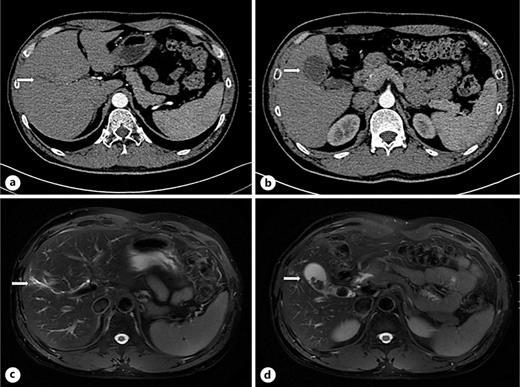 CT and MR images of case 1. a shows the mildly and uniformly dilated bile duct in S5 (arrow) in CT of arterial phase. b shows the gallbladder wall is uniformly thickened and unevenly filling of the gallbladder (arrow) in CT of arterial phase. c shows mild dilatation of the intrahepatic bile duct in S5 with mild inflammatory changes in the surrounding (arrow) in T2-weighted MRI. d shows gallbladder atrophy with multiple stones filled (arrow) in T2-weighted MRI.
